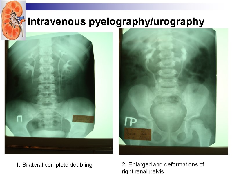Intravenous pyelography/urography 1. Bilateral complete doubling 2. Enlarged and deformations of  right renal